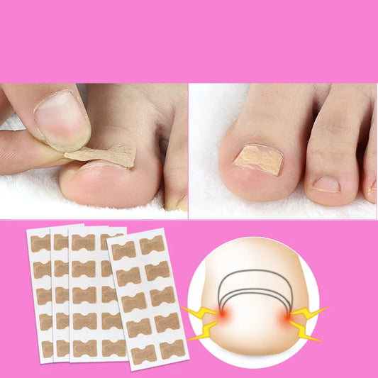 Adesivo para unha encravada - 100 unidades