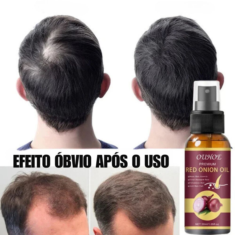 Spray antiqueda ,reparação de folículos capilares para  homens e mulheres.